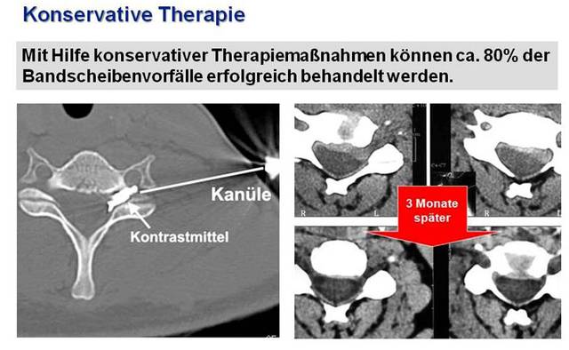 Der behandlung steilstellung lws Osteochondrose: Ursachen,