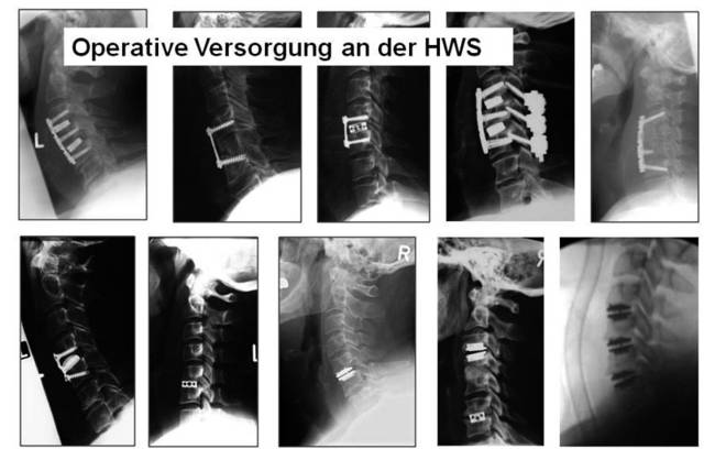 Hws bandscheibenvorfall im Beschwerden der