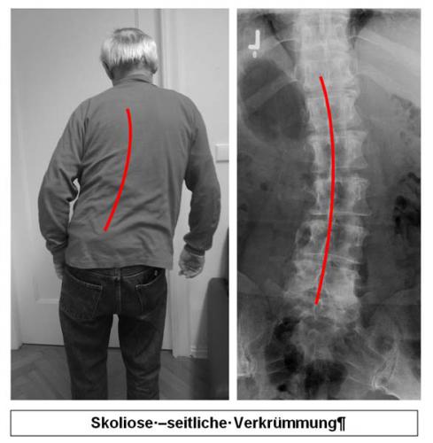 Der behandlung steilstellung lws Osteochondrose LWS